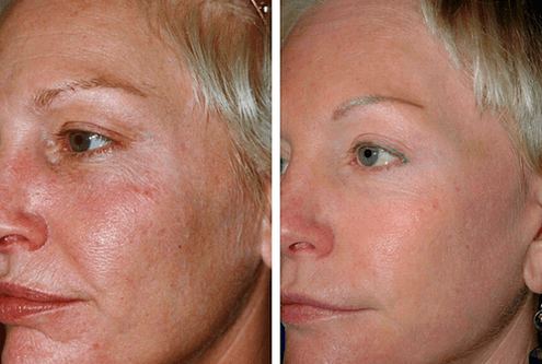 foto enne ja pärast fraktsionaalset naha noorendamist 1