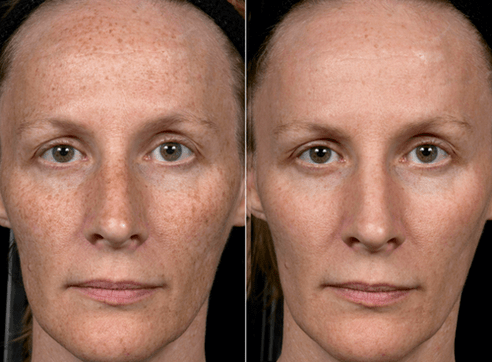 foto enne ja pärast fraktsionaalset naha noorendamist 3