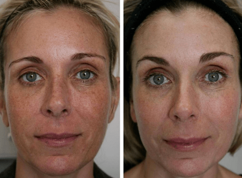 foto enne ja pärast fraktsionaalset naha noorendamist 4