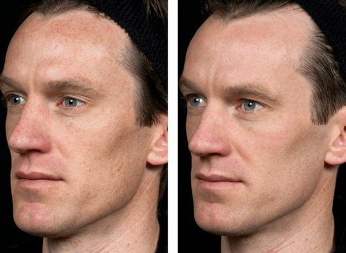 foto enne ja pärast fraktsionaalset naha noorendamist 5