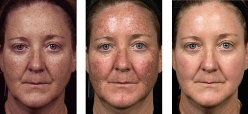 foto enne ja pärast fraktsionaalset naha noorendamist
