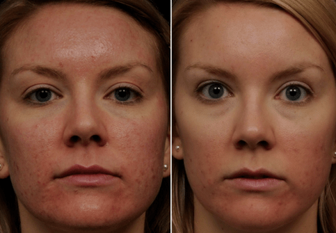 foto enne ja pärast fraktsionaalset nahanoorendamist 6