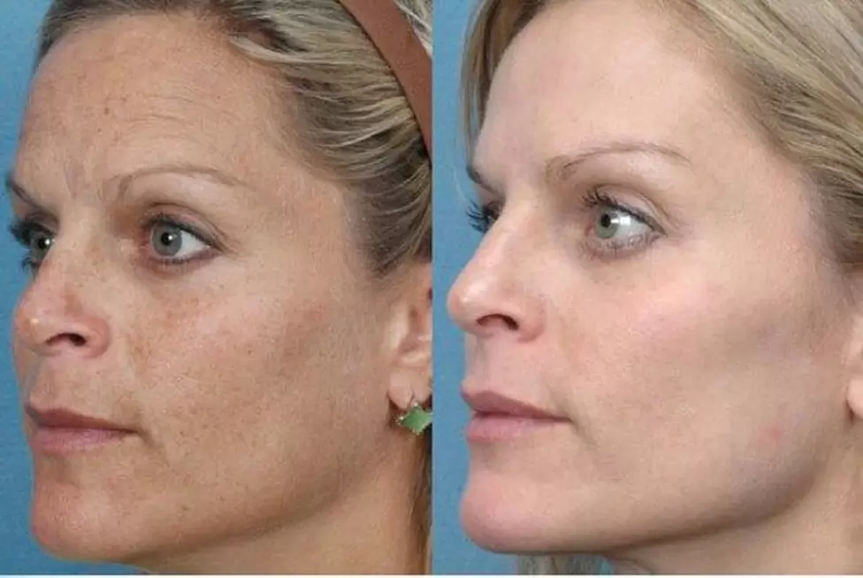 enne ja pärast riistvaralist naha noorendamist, foto 1