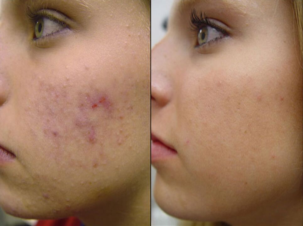 enne ja pärast riistvaralist naha noorendamist, foto 2