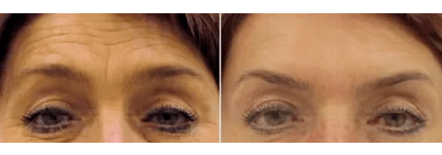 seadmed fraktsionaalseks noorendamiseks