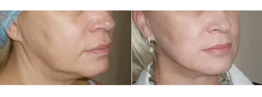 taastumine pärast naha noorendamist